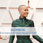 Alopecia kiemelt kép