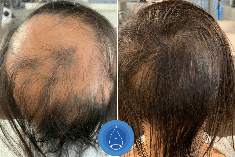 Alopecia-kep-8