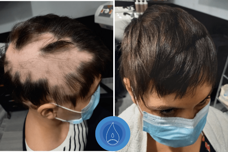Alopecia-kep-9