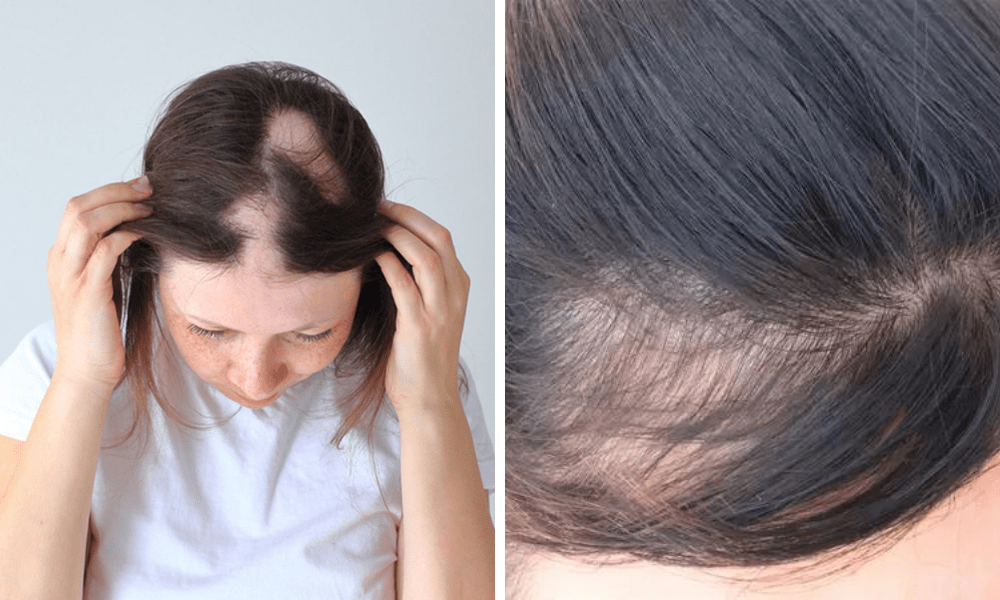 Alopecia kep2
