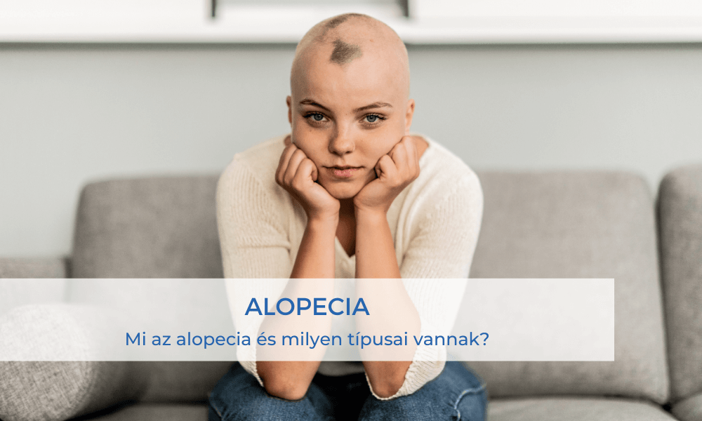 alopecia blog uj 25 02