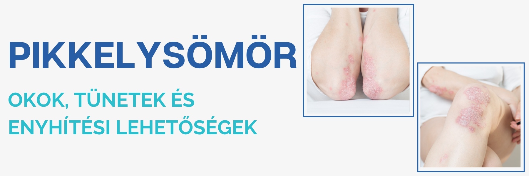 Pikkelysömör 1 pikkelysömör