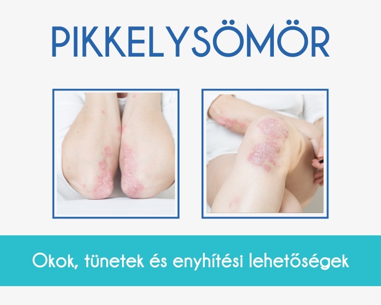 Pikkelysömör 2 pikkelysömör